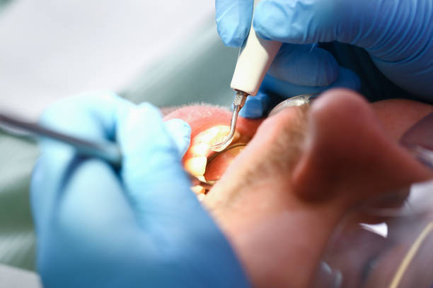 Best Emergency Dentist for Lost Fillings or Crowns in Shelbyville, KY